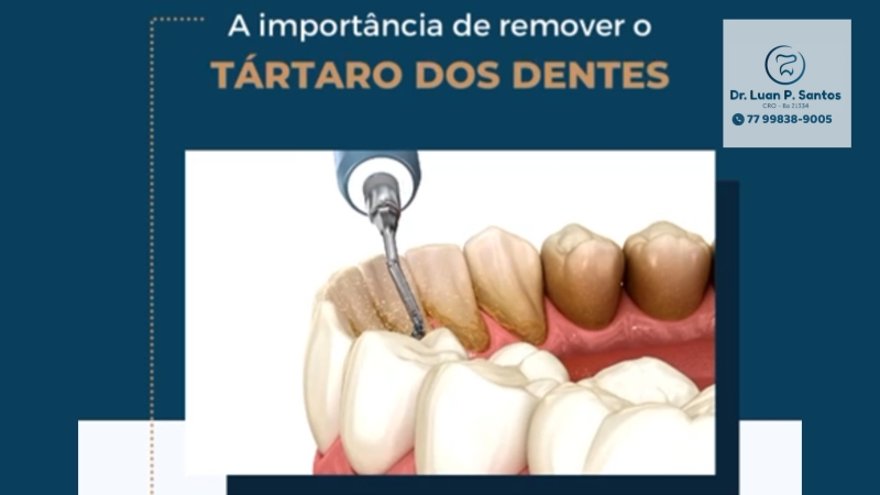 A importância de remover o Tártaro dos dentes